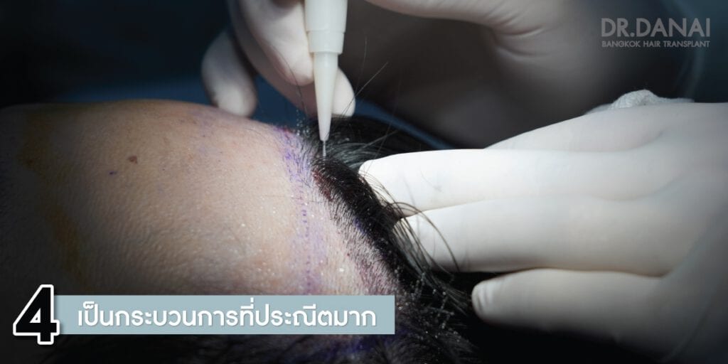 4  ข้อดีของการปลูกผม แบบ DHI